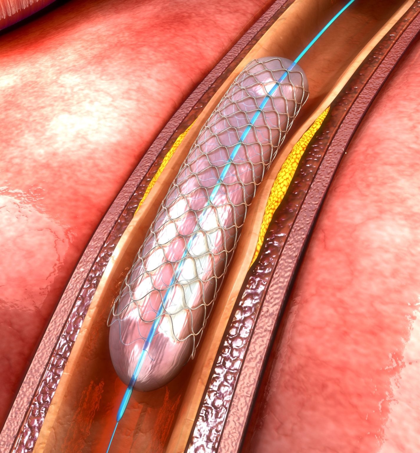 Cardiac Catheterization - Lake Area Cardiology